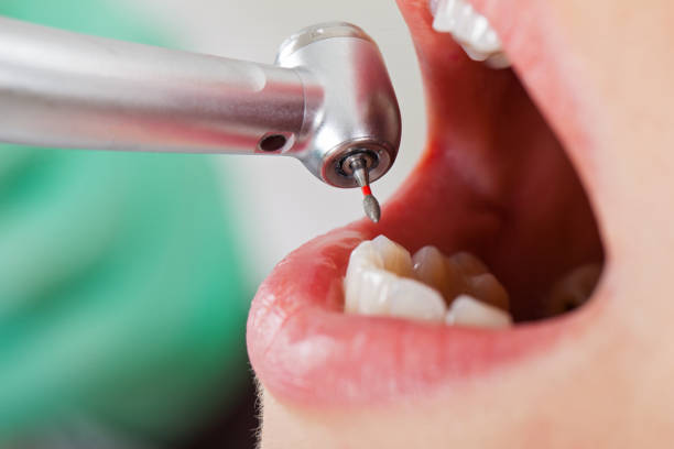 Best Urgent Care for Lost Fillings or Crowns in Superior, WI